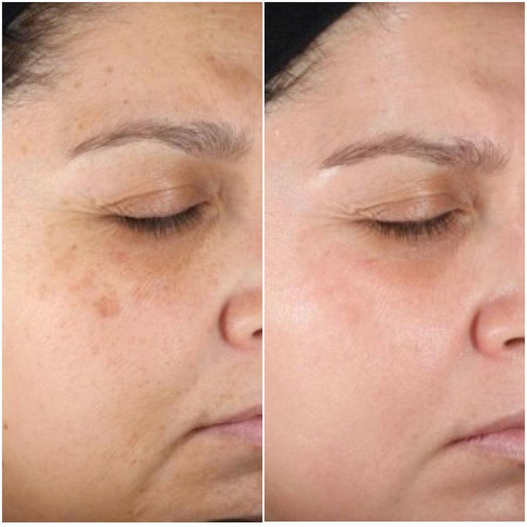 Walis B Anti-Aging Retinol Serum - Women
